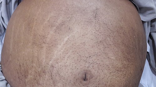 Striae alba stretch marks