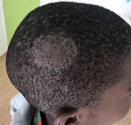 טינאה קפיטיס