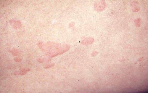 אורטיקריה חריפה