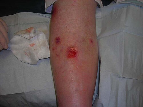 Venous leg ulcer