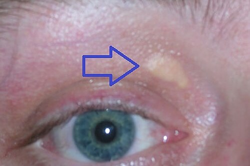 Xanthelasma palpebrarum